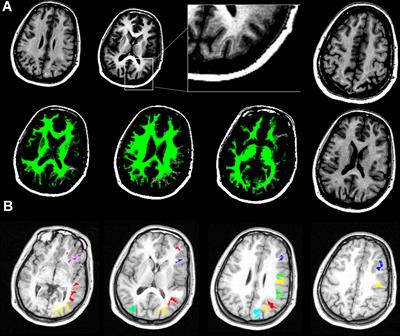 Functional Connectivity and Genetic Profile of a “Double-Cortex”-Like Malformation